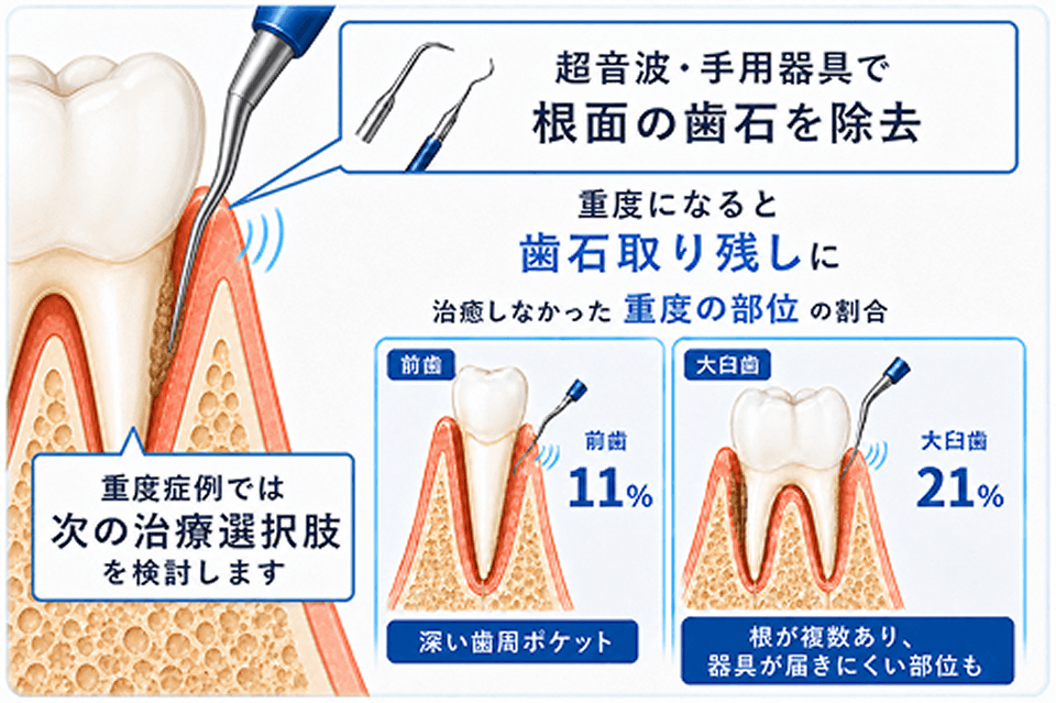 深い歯周ポケットでは、器具が届きにくい部位も