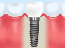 インプラント