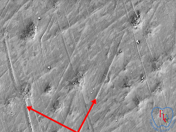 歯の表面に傷がついている　研磨ペーストによる「研磨」後
