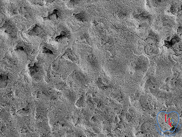 傷が付かず細菌が除去されているエアフローパウダー プラスによる清掃後